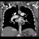 Chronic lung embolism, pulmonary hypertension, webs, adherent thrombi: CT - Computed tomography